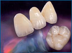 Posterior-Crowns-Or-Inlay-Retained-Bridges-Carried-Around-Everyday-Is-Made-Of-Chemical-Strengthen-Glass-Ceramic Posterior-Crowns-Or-Inlay-Retained-Bridges-Carried-Around-Everyday-Is-Made-Of-Chemical-Strengthen-Glass-Ceramic.png